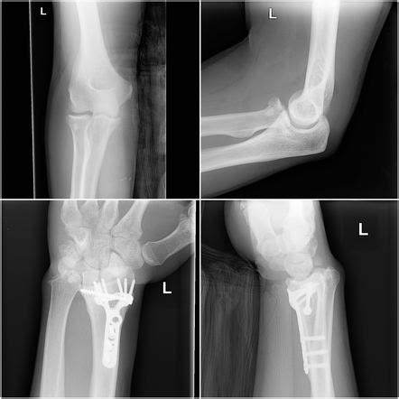 Essex Lopresti Fracture Dislocation Radiology Reference Article Hot