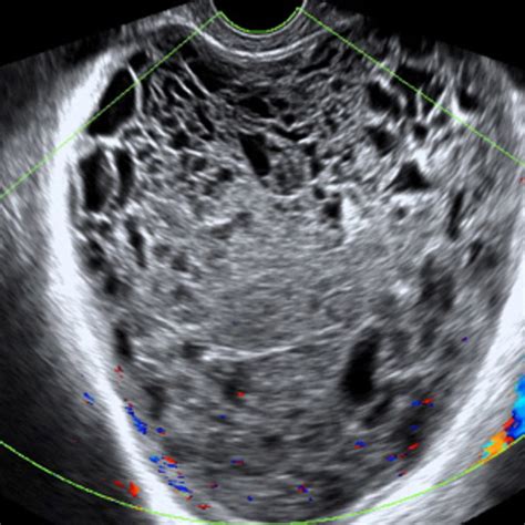 Ovarian Cyst And Cancer Ultrasound