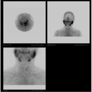 Technetium M Tc M Pertechnetate Scintigraphy Of The Patients