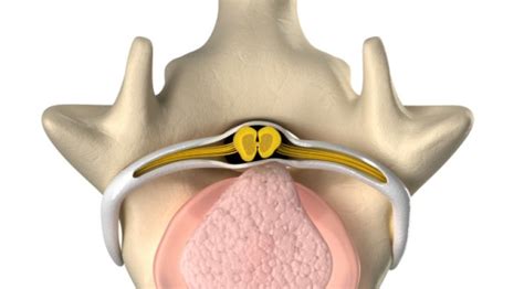 Lumbago Symptome Dauer Therapie Des Hexenschuss