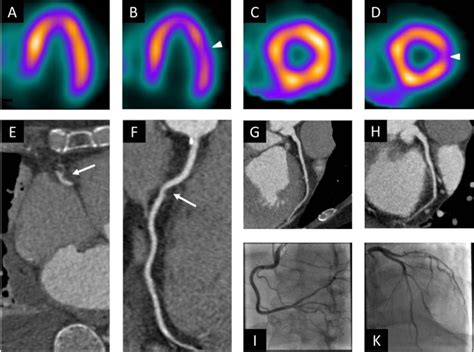 Diagnostic Yield And Accuracy Of Coronary Ct Angiography After Abnormal