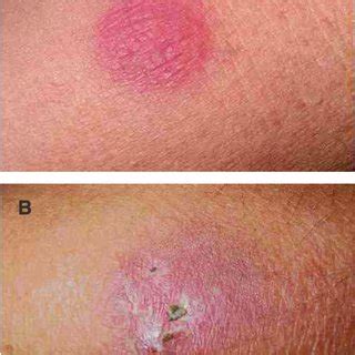 Erythema Induratum Of Bazin Nodular Vasculitis Erythematous Nodules