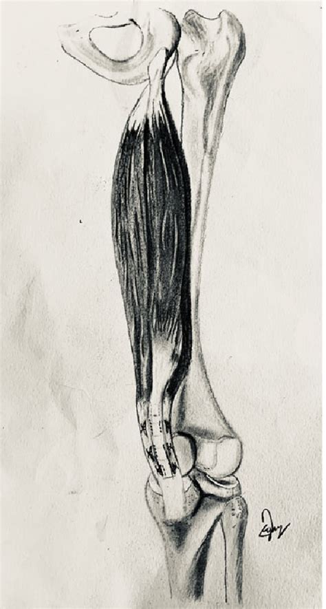 Surgical Illustration Demonstrating A Semitendinosus St Download