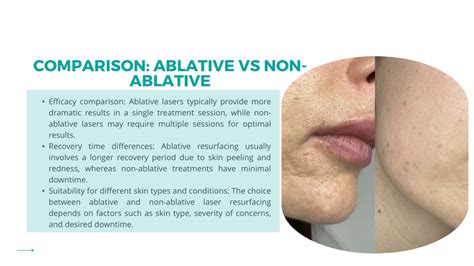 Ppt Laser Resurfacing Ablative Vs Non Ablative Skin Treatment