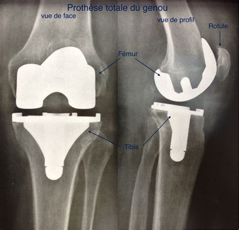 PROTHESE TOTALE DU GENOU Chirurgie Orthopédique Sainte Marie