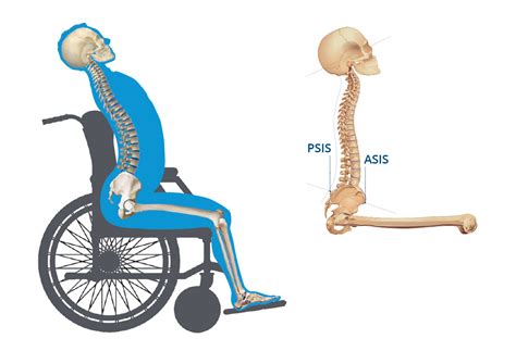 Anterior Pelvic Tilt: Causes and Solutions through Wheelchair Positioning