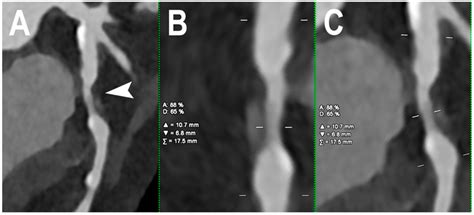 Cardiac Pcct Example Of Obstructive Cad The Figure Shows An Example Of Download Scientific