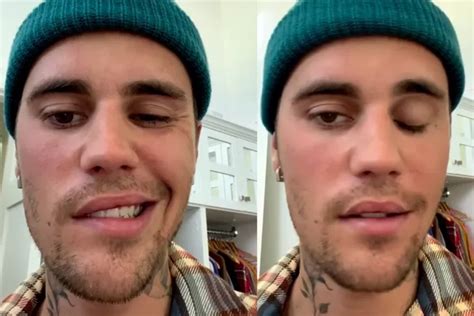 Justin Bieber Idap Ramsay Hunt Syndrome Hingga Wajahnya Lumpuh Sebelah