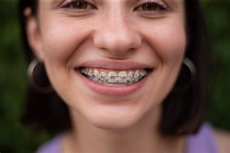 Can Braces Fix Asymmetrical Face Unlock Your Perfect Smile