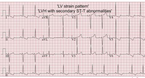 Atrial Enlargement And Ventricular Hypertrophy Flashcards Quizlet