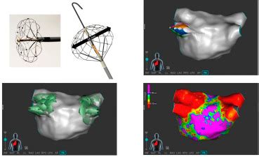 PO 06 159 RAPID LEFT ATRIAL ANATOMICAL RENDERING AND PULMONARY VEIN