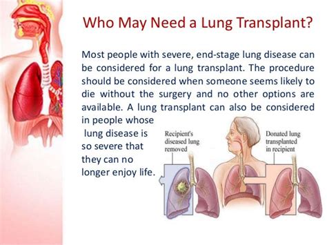 Lung Transplant Surgery in India