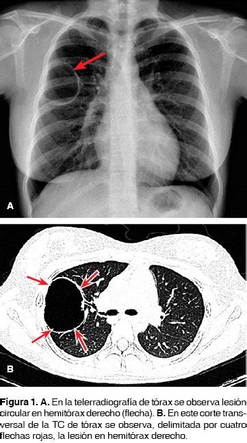 Abordaje De Lesiones Cavitadas Pulmonares Lesión Quística Pulmonar