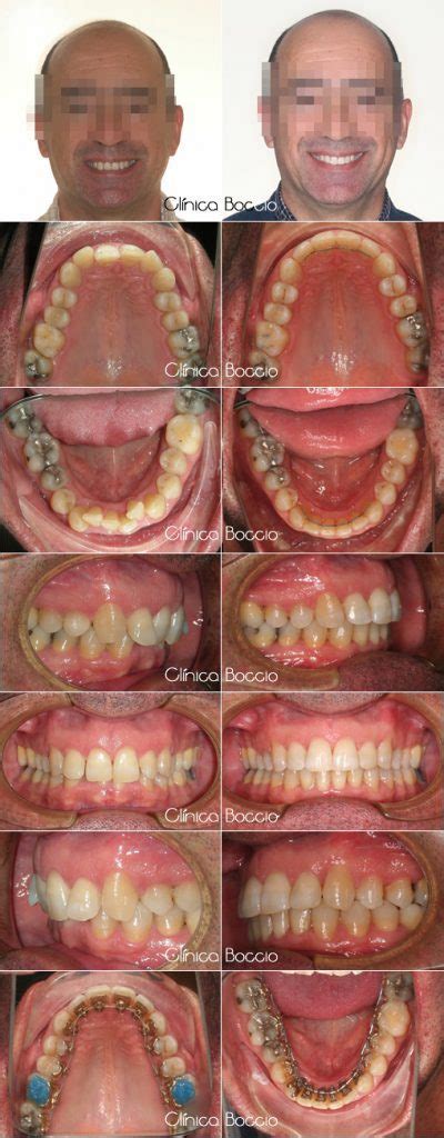 Sobremordida Y Apiñamiento Clínica Boccio Ortodoncia Huelva