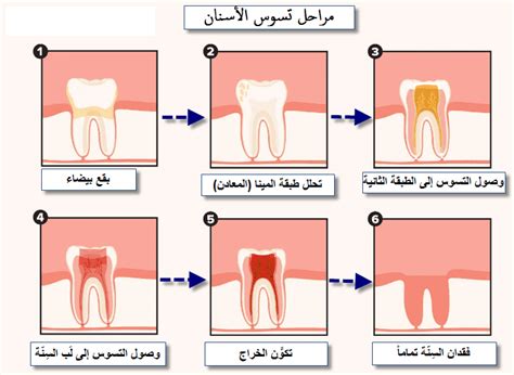 تسوس الأسنان أسباب، أعراض، علاج وشرح كيف يحدث