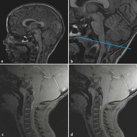 Cerebellar Tonsils Mri