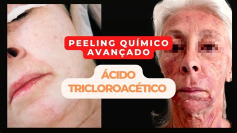 Como é o processo do Peeling Ácido Tricloroacético Efeito Cirúrgico