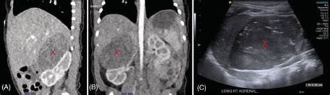 Right Adrenal Mass Marked With X Shown On Initial Sagittal Ct A