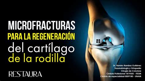 Microfracturas Para La Regeneración Del Cartílago De La Rodilla Youtube