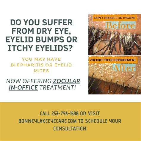 Zocular Zest Treatment For Dry Eyes And Eyelid Mites