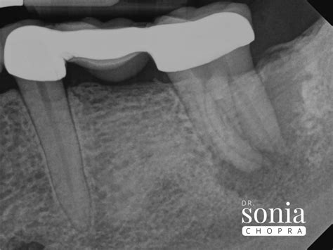 A Tooth Story Of Necrotic Pulp Diagnosis Sonia Chopra Dds