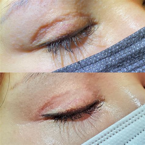 Atrophic Scar Treatment Before and After - Scar Healing Institute