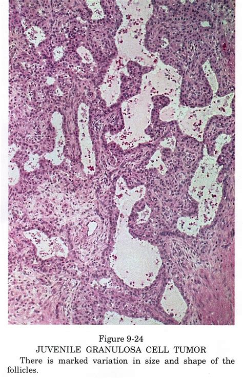 Pathology Outlines Granulosa Cell Tumor Juvenile