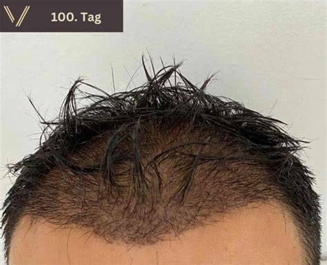 Haartransplantation Wachstum Zeitplan Täglich Erholung Fotos