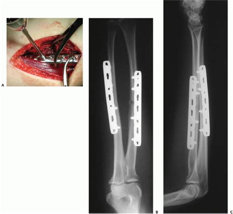 Radial And Ulnar Shaft Fractures Teachme Orthopedics