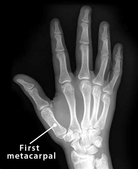 First Base Of Metacarpal
