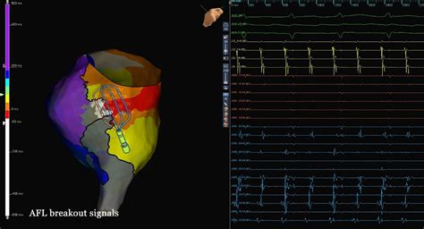 Advisor Hd Grid Mapping Catheter Se Case Library Abbott