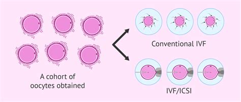 Ivf Or Icsi What Is The Difference Which Is Better