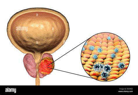 La Etiolog A Viral Del C Ncer De Pr Stata Ilustraci N Conceptual