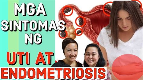 Mga Sintomas Ng Uti At Endometriosis By Catherine Howard Ob Gyne