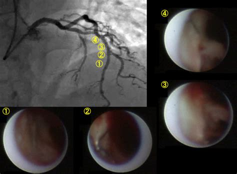 Very Late Stent Thrombosis At Years After Sirolimus Eluting Stent