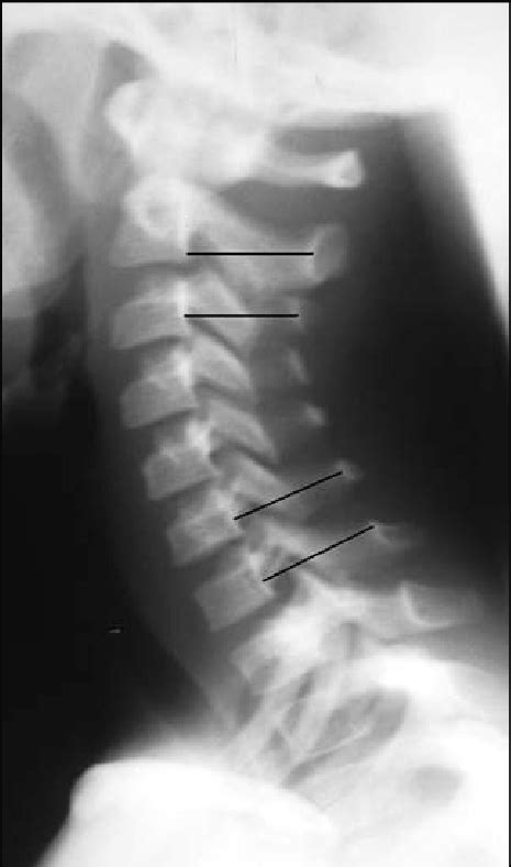 Lateral Cervical Spine Radiograph Download Scientific Diagram