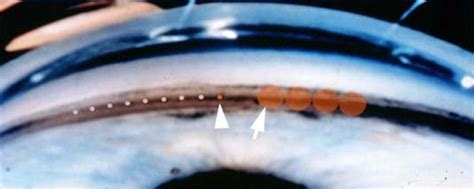 Argon Laser Trabeculoplasty Alt Spot Size Left Arrow Versus