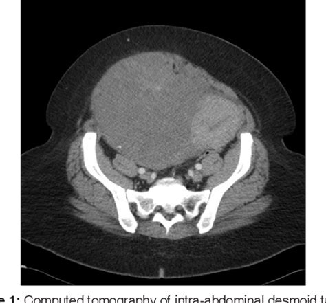 Figure 1 From Resection Of A Large Intra Abdominal Desmoid Tumor Requiring Abdominal Wall