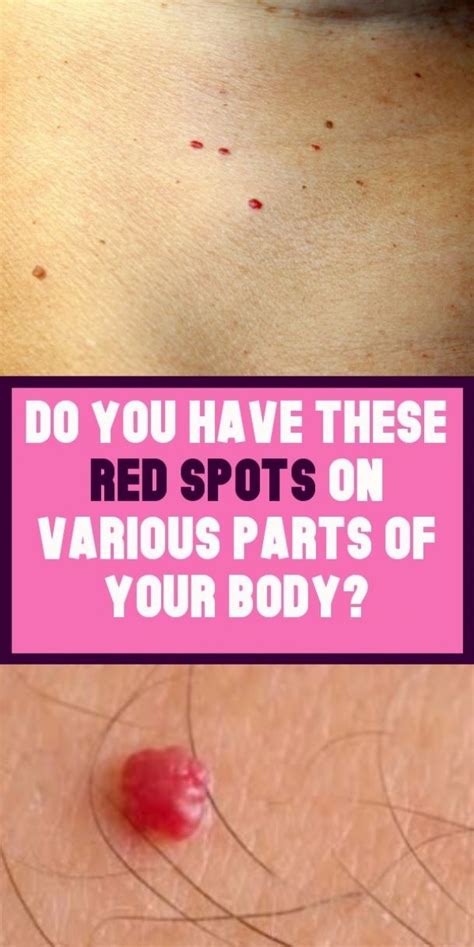 Do You Have These Red Spots In Different Parts Of The Body Body