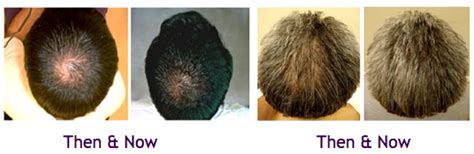 Revivogen Scalp Therapy | Vivandi - One Stop Solutions for Hair Loss in Dubai, UAE, Toronto and ...