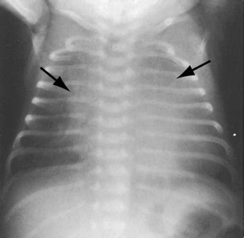 Patent Ductus Arteriosus Aortopulmonary Window Springerlink Off