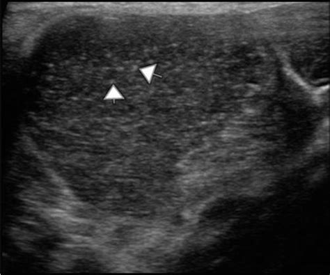 The Role Of Ultrasound In Hypothyroidism Technique Differential