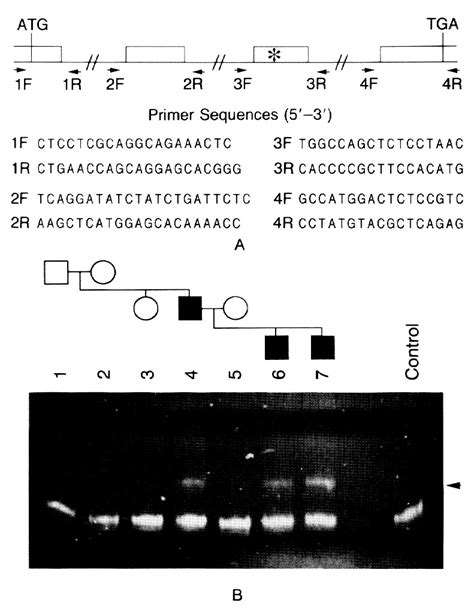 Charcot Marie Tooth Disease Type 1a Association With A Spontaneous