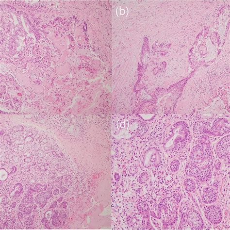 Histologic Features Of A Case Of Mucoepidermoid Carcinoma MEC Mixed