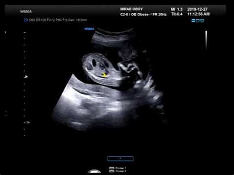 Update 4 Months Pregnant Ultrasound And 3D YouTube