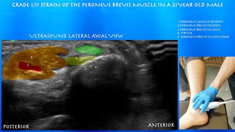 Ultrasound Of A Peroneus Brevis Strain In A 21 Year Old Male By Youtube