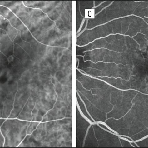 Stage 1 Retinal Angiomatous Proliferation Rap Angiograms Obtained At