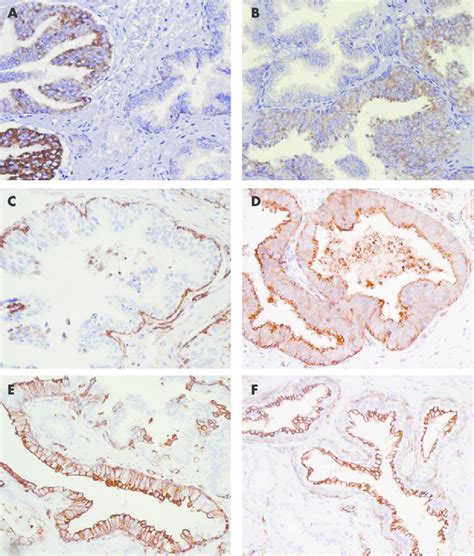 High Grade Prostatic Intraepithelial Neoplasia HGPIN Staining