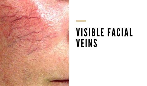 Spider Veins On Face