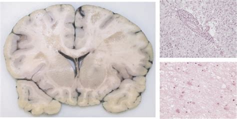 Multiple Sclerosis And Demyelination Current Diagnostic Pathology